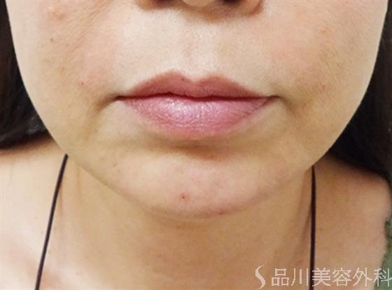 症例NO.34706のAFTER写真