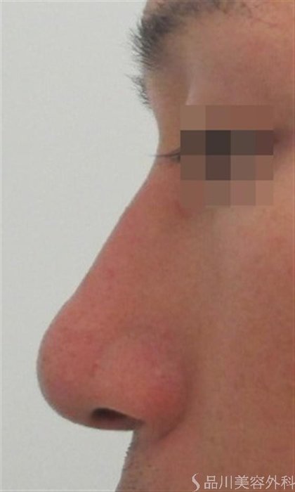 症例NO.22954のAFTER写真