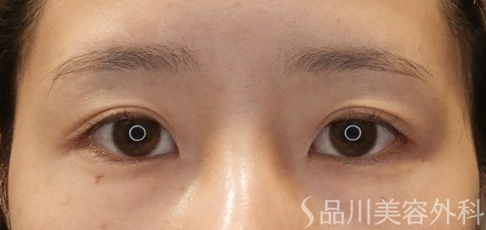 症例NO.68027のBEFORE写真