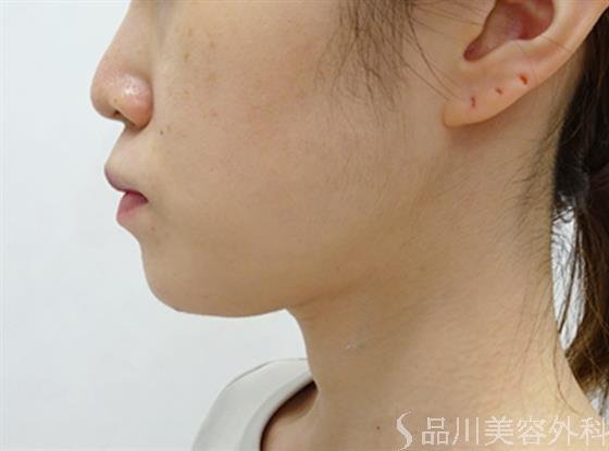 症例NO.51373のBEFORE写真