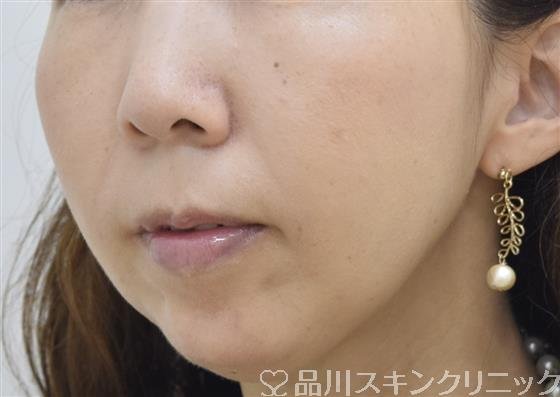 症例NO.43230のAFTER写真