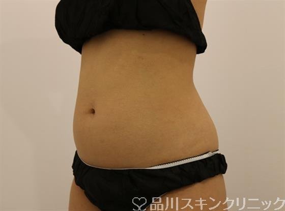 症例NO.45954のBEFORE写真