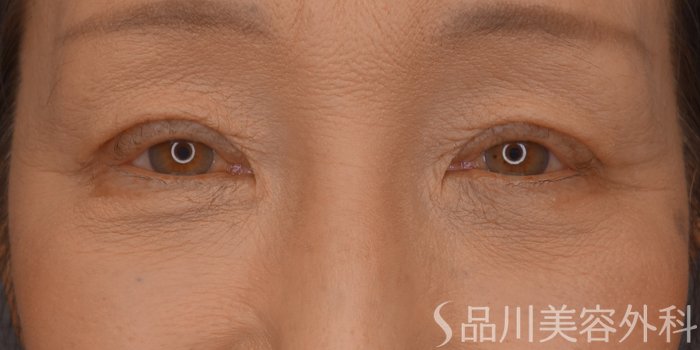 症例NO.73421のAFTER写真