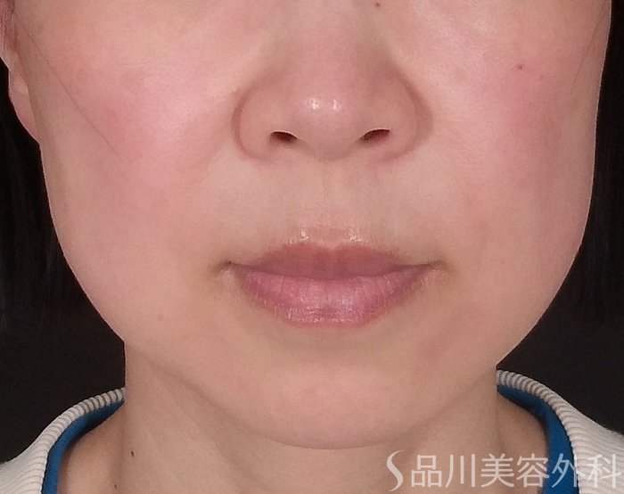 症例NO.70366のBEFORE写真