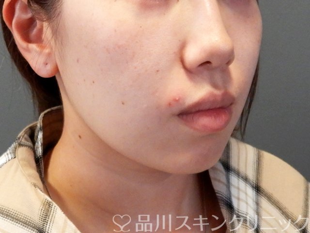 症例NO.67436のBEFORE写真