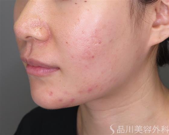 症例NO.47634のBEFORE写真