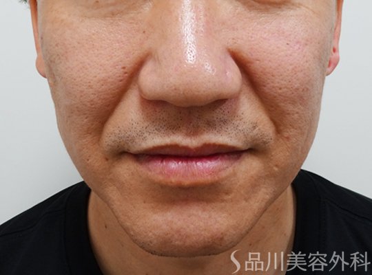 症例NO.73521のBEFORE写真