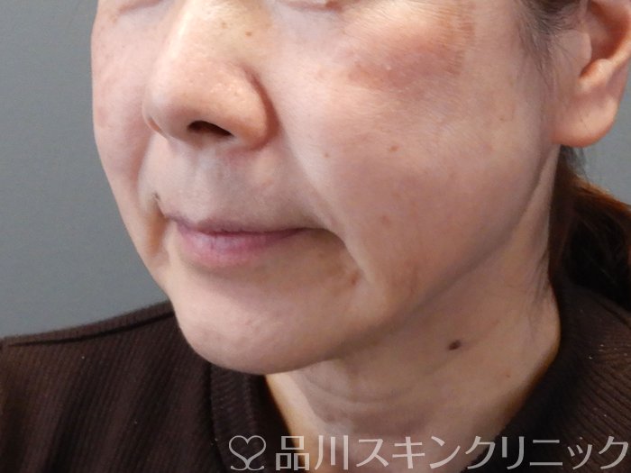 症例NO.73073のBEFORE写真