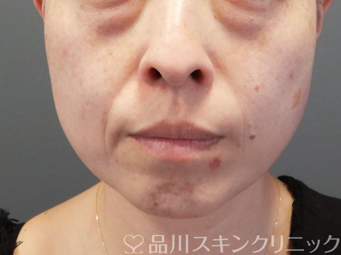 症例NO.72769のBEFORE写真