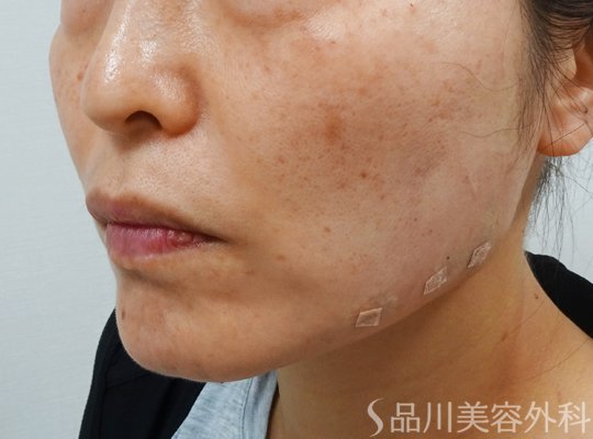 症例NO.73393のAFTER写真