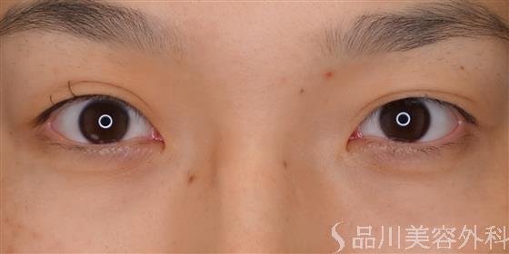 症例NO.52255のBEFORE写真