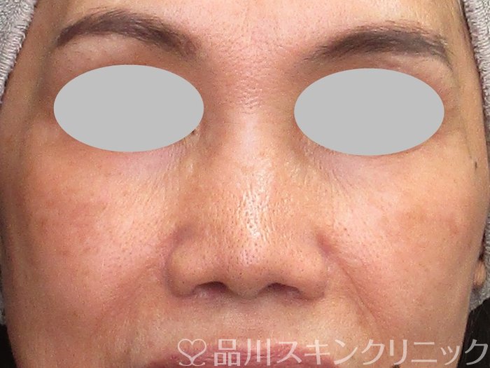 症例NO.73305のBEFORE写真