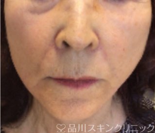 症例NO.71143のAFTER写真