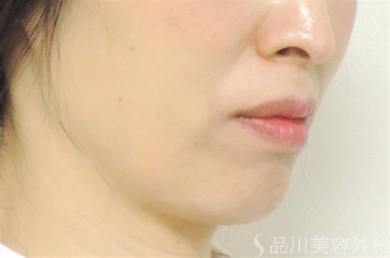 症例NO.21032のBEFORE写真