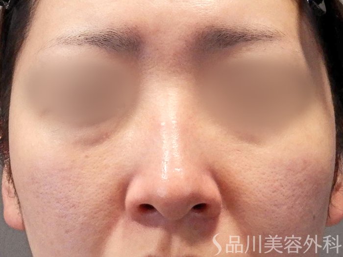 症例NO.65543のBEFORE写真