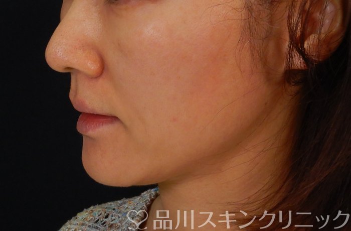 症例NO.66425のBEFORE写真