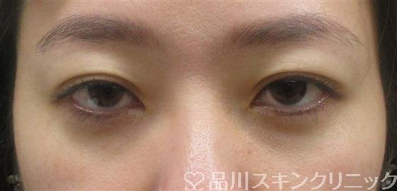 症例NO.60357のAFTER写真