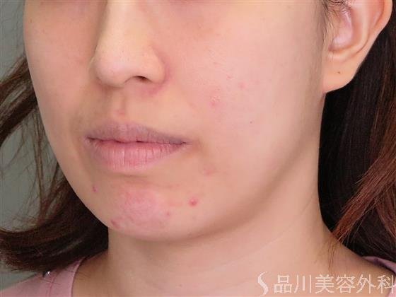 症例NO.47524のBEFORE写真