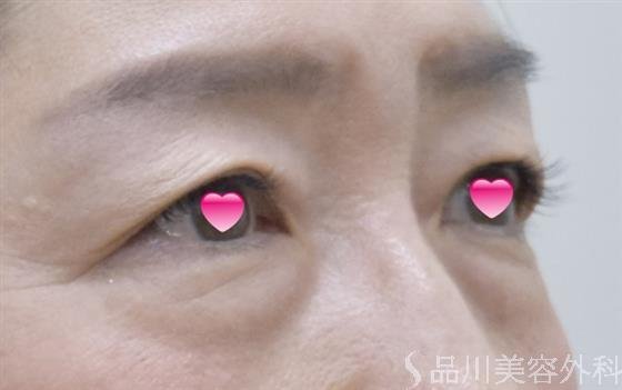 症例NO.52440のBEFORE写真