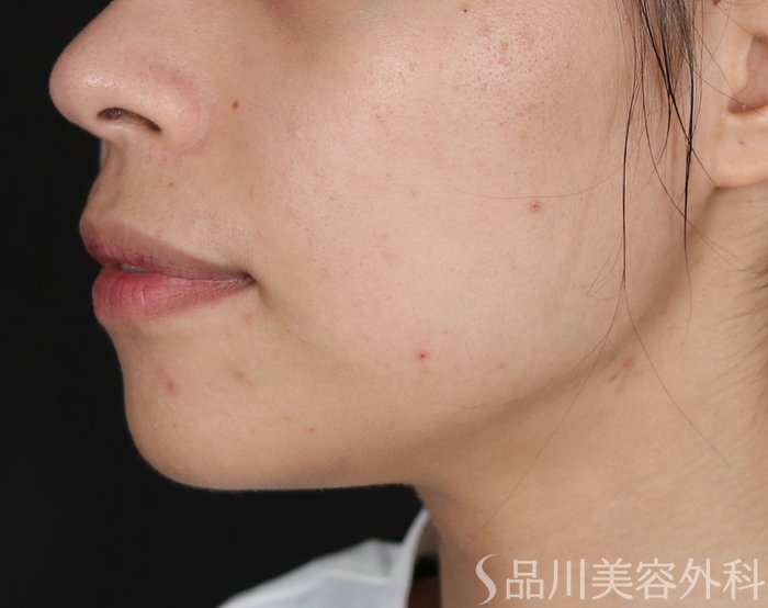 症例NO.71959のBEFORE写真