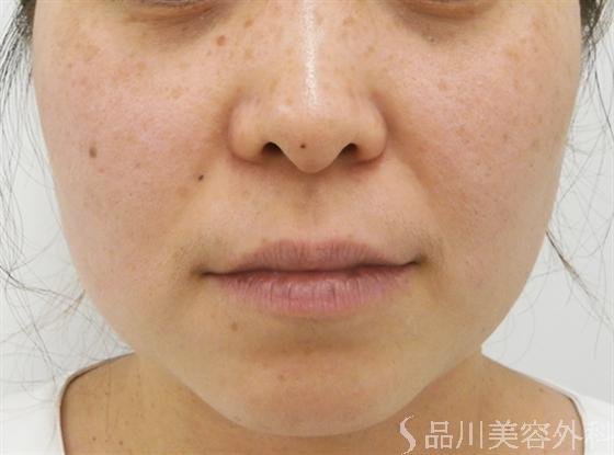 症例NO.14547のBEFORE写真