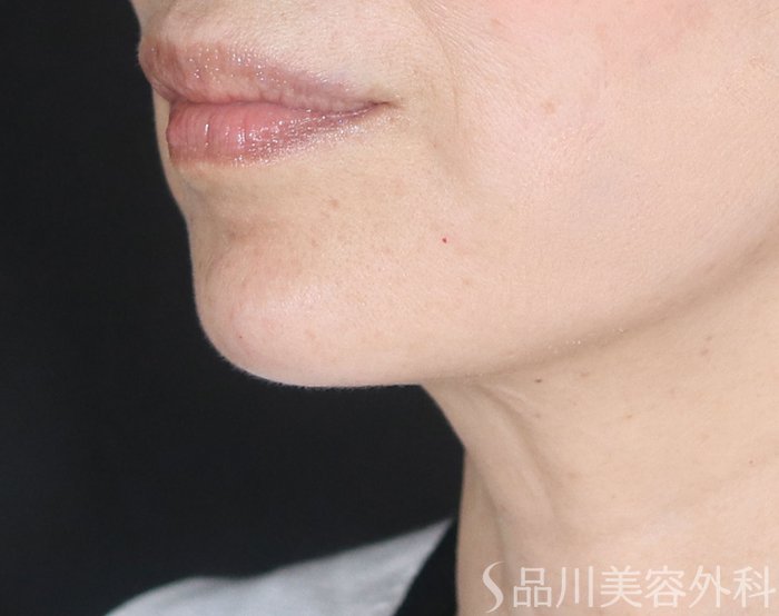 症例NO.73580のAFTER写真