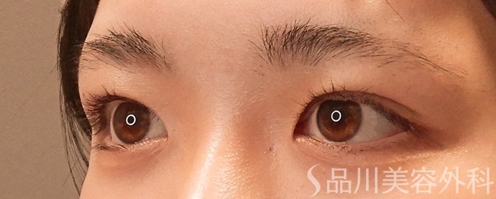 症例NO.69928のAFTER写真
