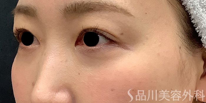症例NO.69662のAFTER写真