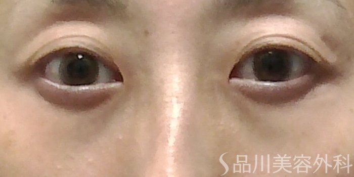 症例NO.70704のAFTER写真