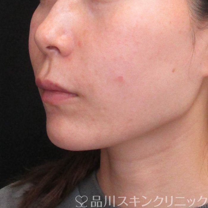 症例NO.73274のBEFORE写真