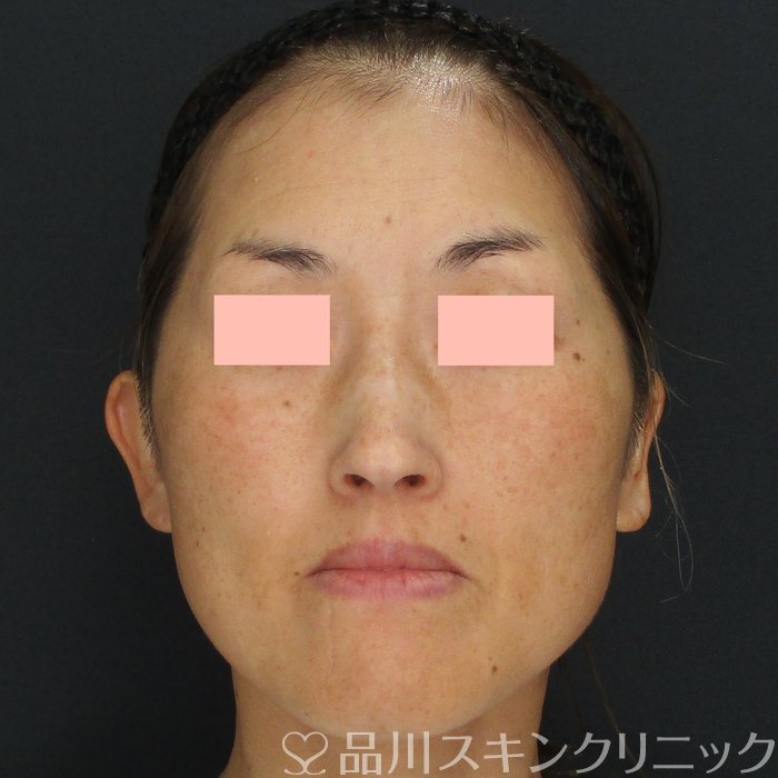 症例NO.73571のBEFORE写真