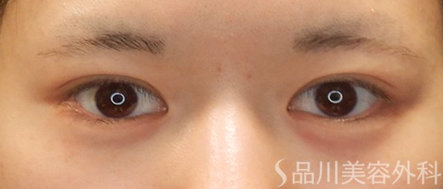 症例NO.73254のAFTER写真