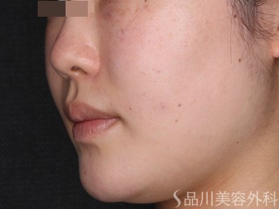 症例NO.74134のAFTER写真