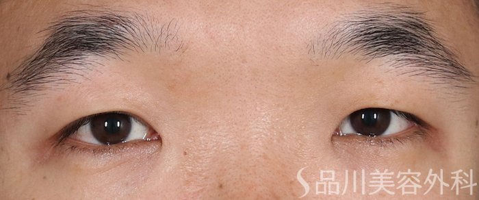 症例NO.74082のBEFORE写真