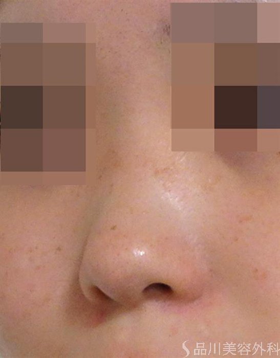 症例NO.39018のBEFORE写真