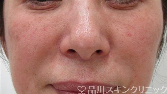 症例NO.32600のAFTER写真