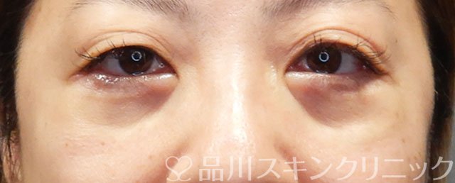 症例NO.72694のAFTER写真