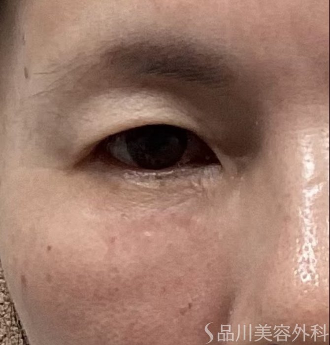 症例NO.68153のAFTER写真