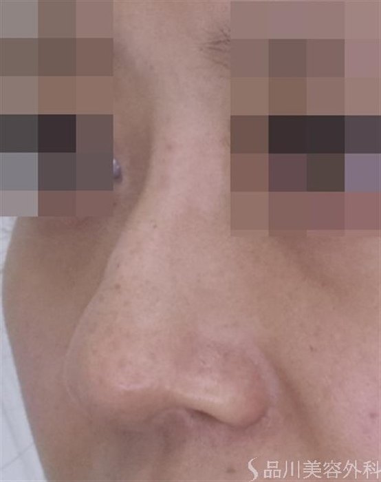 症例NO.51562のAFTER写真