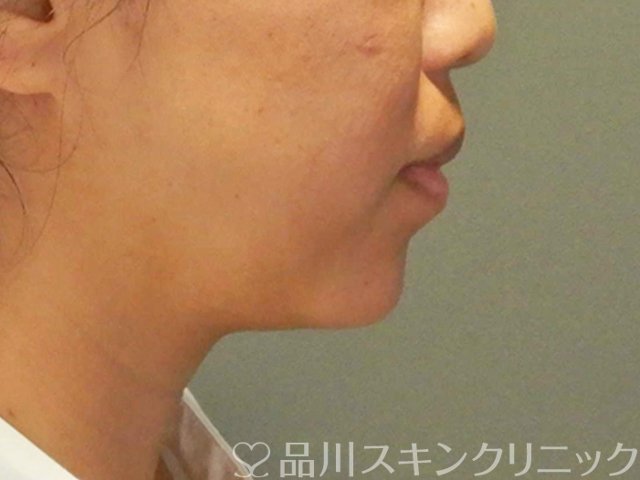 症例NO.66918のAFTER写真
