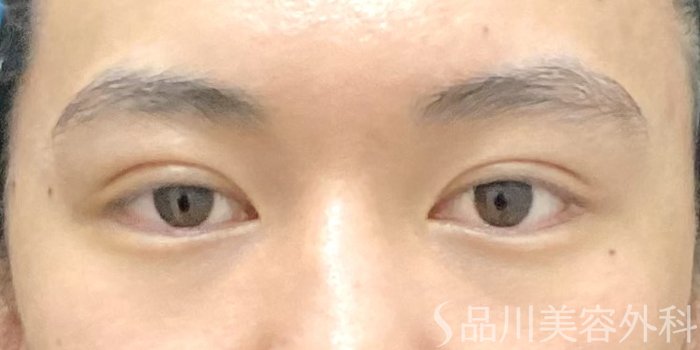 症例NO.69743のAFTER写真