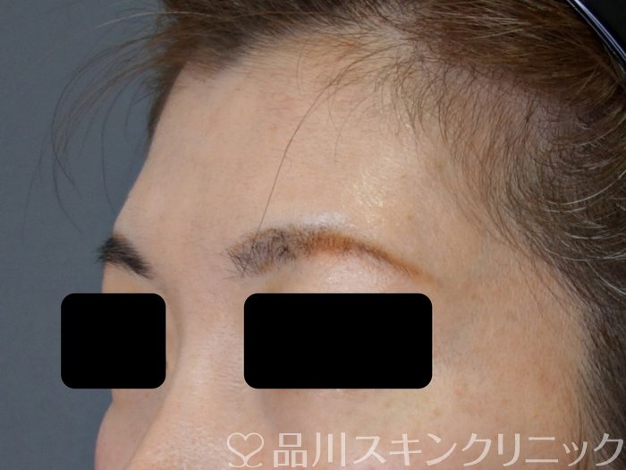 症例NO.73342のBEFORE写真