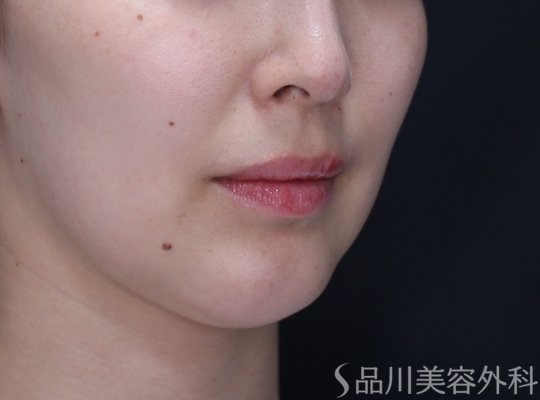 症例NO.71719のBEFORE写真