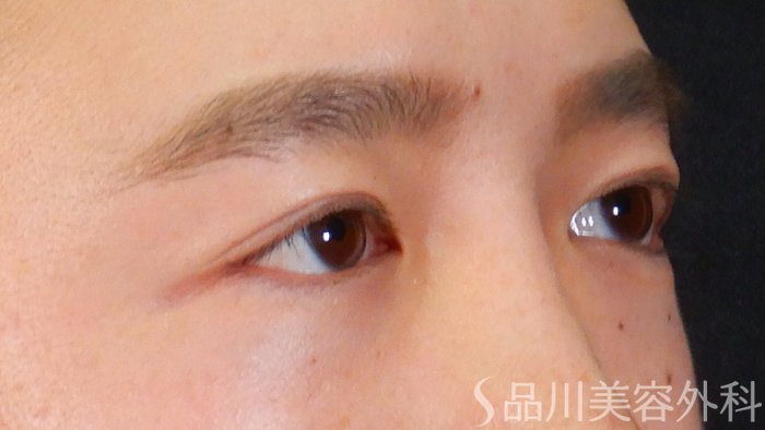 症例NO.67567のAFTER写真
