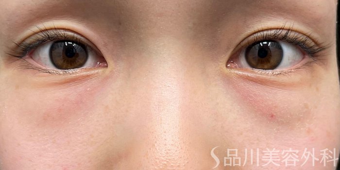 症例NO.65558のBEFORE写真