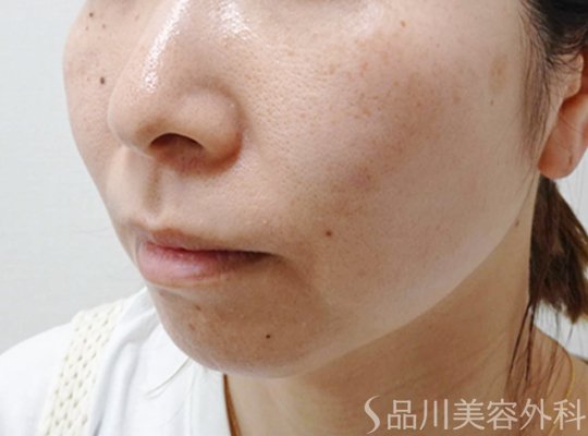 症例NO.74061のBEFORE写真