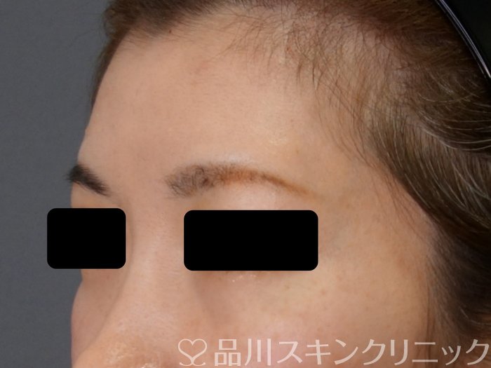 症例NO.73342のAFTER写真