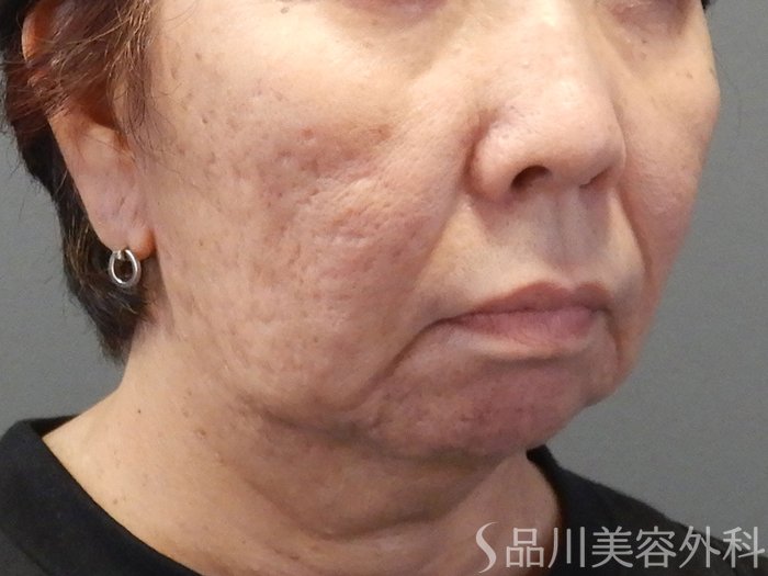 症例NO.68011のBEFORE写真