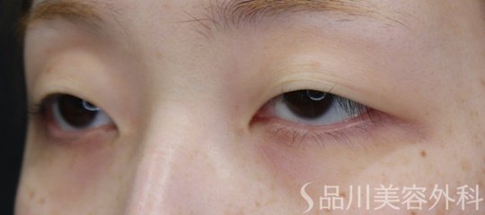 症例NO.71896のBEFORE写真