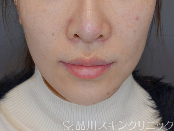 症例NO.72578のBEFORE写真